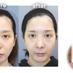 エンリケ、整形失敗でサバイバル！後悔の念と苦しいダウンタイムを告白