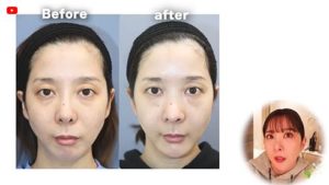 エンリケ、整形失敗でサバイバル！後悔の念と苦しいダウンタイムを告白