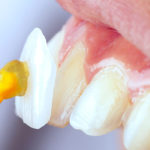 歯のラミネートベニアの寿命は？長持ちする秘訣とは