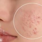 美容系インスタグラマーNanaさんの爆弾ニキビ肌を克服した美肌ストーリー