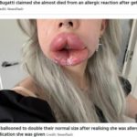 リップフィラー溶解施術で唇が「巨大タラコ」に！