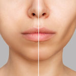 美容医療で頬がこけるリスク？慎重な選択が必要な理由とは？
