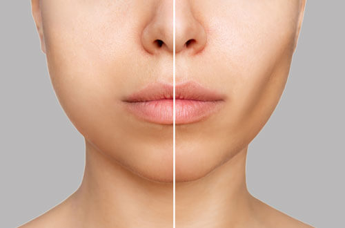 美容医療で頬がこけるリスク？慎重な選択が必要な理由とは？
