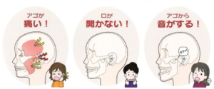 顎関節症の注意点とは？「もしかして…」と思ったらやってはいけないこと３つ！