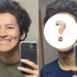 北村匠海似整形美男、30万円で両顎手術で人生が大変化！