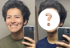 北村匠海似整形美男、30万円で両顎手術で人生が大変化！