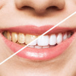 歯科医が解説！ホワイトニングのメリット・デメリットとは？