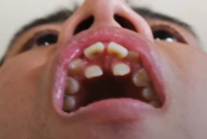 歯列矯正で後悔しないためのポイントとは？井口が審美治療を受ける前歯の変化を語る