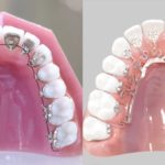 「痛くない・違和感が少ない！最新の裏側矯正Brava（ブラーバ）の魅力とは？」