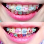 歯列矯正後の後悔原因として、保定が不足していることがある！対策とは？