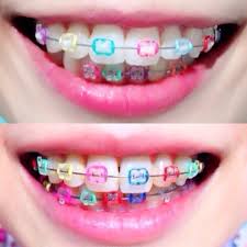 歯列矯正後の後悔原因として、保定が不足していることがある！対策とは？