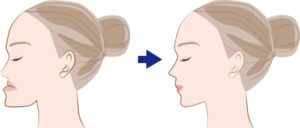 SSRO整形で両顎を動かした結果、3日間の苦痛―気管切開のリスクを考える