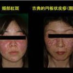 夏バテと勘違い？実は全身性エリテマトーデスを発症した私の苦悩