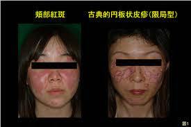 夏バテと勘違い？実は全身性エリテマトーデスを発症した私の苦悩