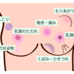 乳がんになると乳房に現れるくぼみ、その意味とは？