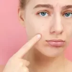 米国皮膚科学会が発表した新ガイドライン！ニキビ治療の最前線を紹介