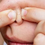 黒いブツブツが気になる人必見！いちご鼻の原因と対策ケアを専門医が解説！