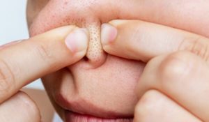 黒いブツブツが気になる人必見！いちご鼻の原因と対策ケアを専門医が解説！