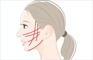 リフトアップ系処置を検討中？知っておきたい3つの選択肢