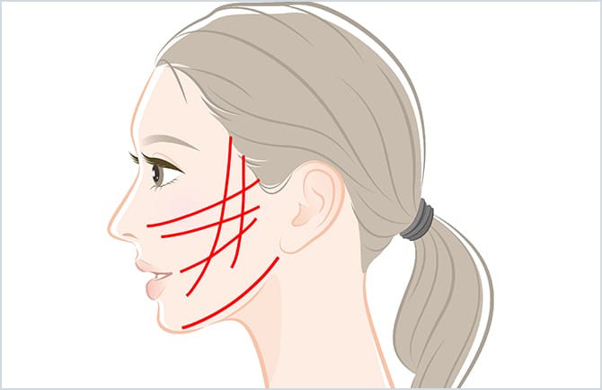 リフトアップ系処置を検討中？知っておきたい3つの選択肢