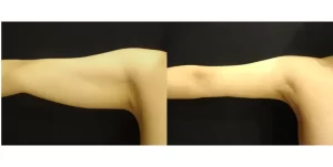 医師が解説する「脂肪吸引」リバウンドの真実とは？