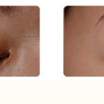 「50歳体当たり取材！顔の「ほくろ」を取ってみたらどうなった？値段は？結果は！？」